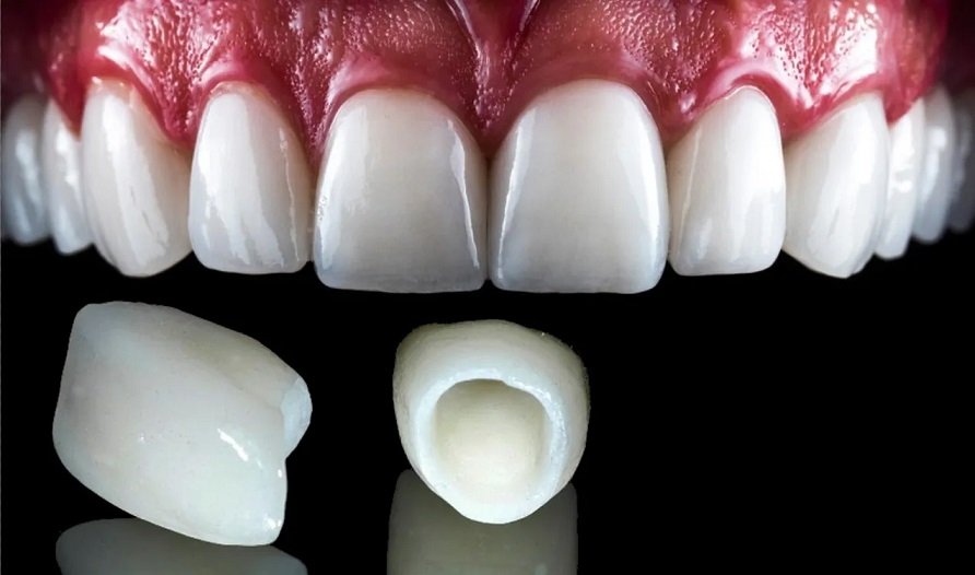 Zirconia Crown Price: Are You Getting the Real Value of What You Are Paying? 